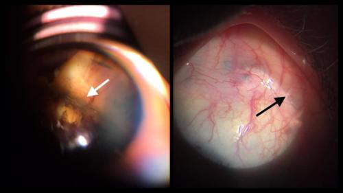 Scleral buckle - cerclage